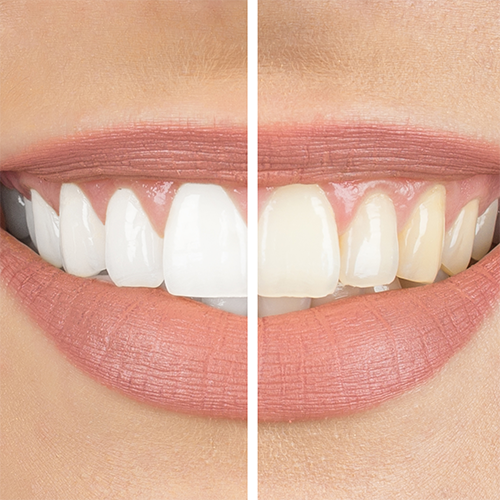 teeth-cleaning-vs-teeth-whitening-summerlin-dental