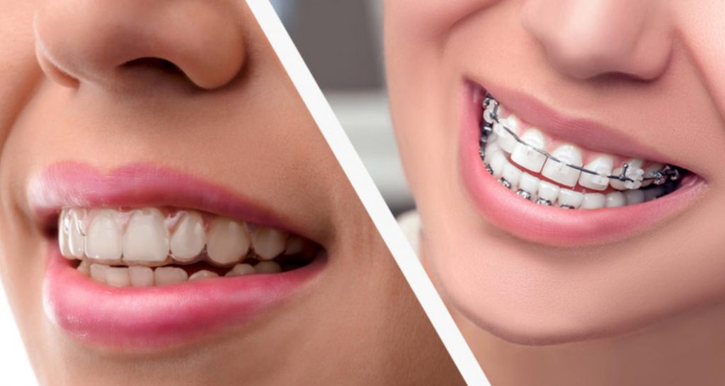 Wichita Dentist - Invisalign vs Traditional Braces